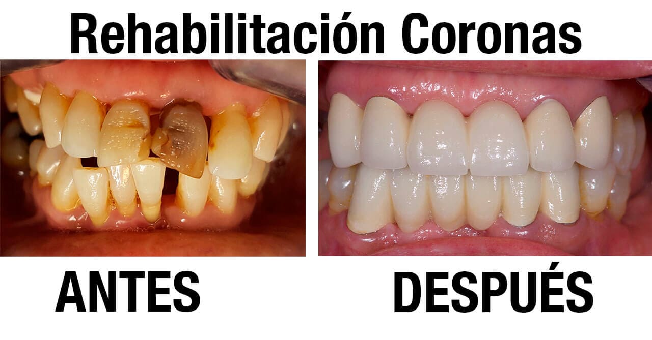 DRA. PATRICIA SERRANO ANAYA - Rehabilitación Dental