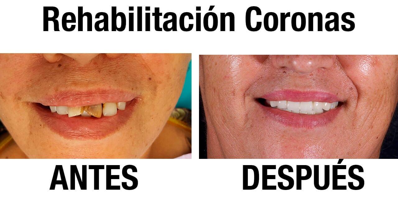 DRA. PATRICIA SERRANO ANAYA - Restauración de Dientes