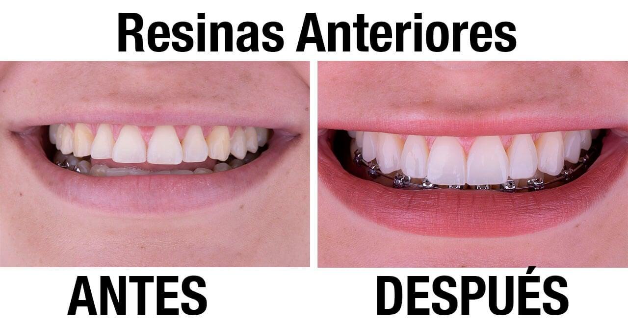 DRA. PATRICIA SERRANO ANAYA - Resinas Anteriores