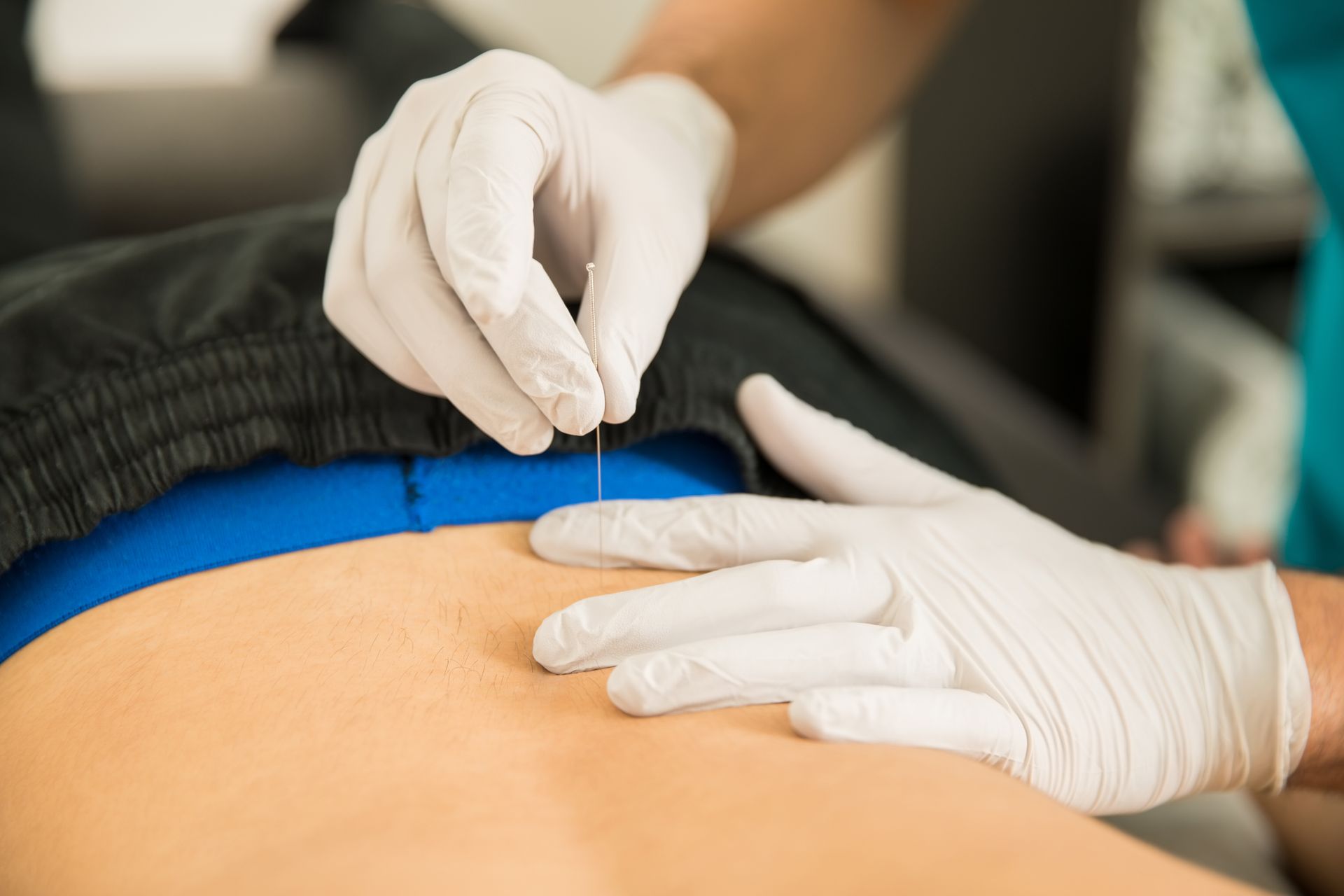 Hands in gloves performing acupuncture on a person's back in Eastover, NC.