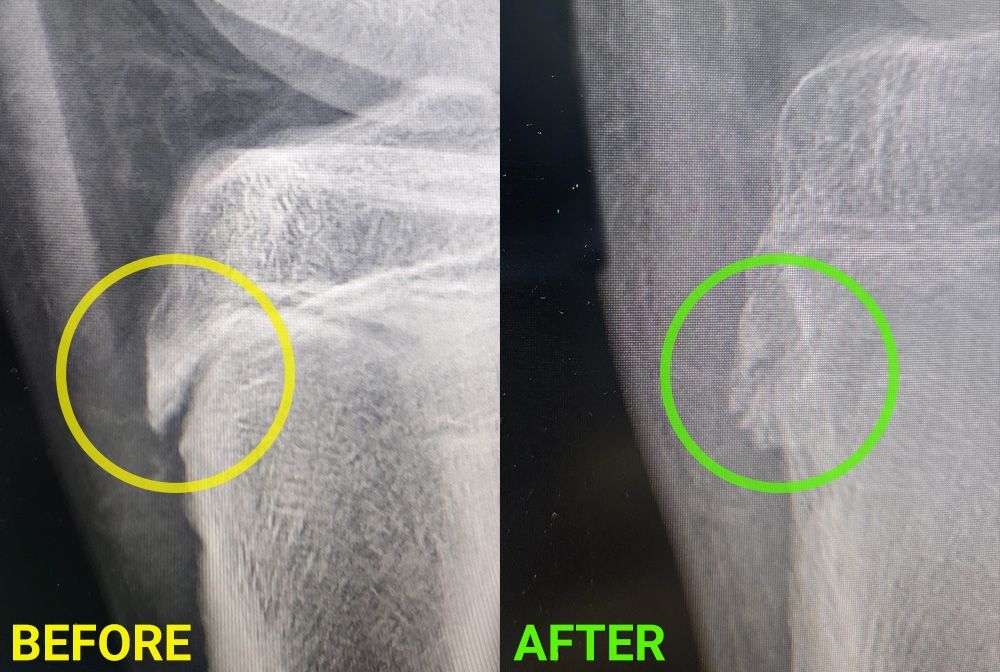 X-ray comparison. Before: Normal bone structure, yellow circle. After: Bone shows a fracture, green circle in Eastover, NC.