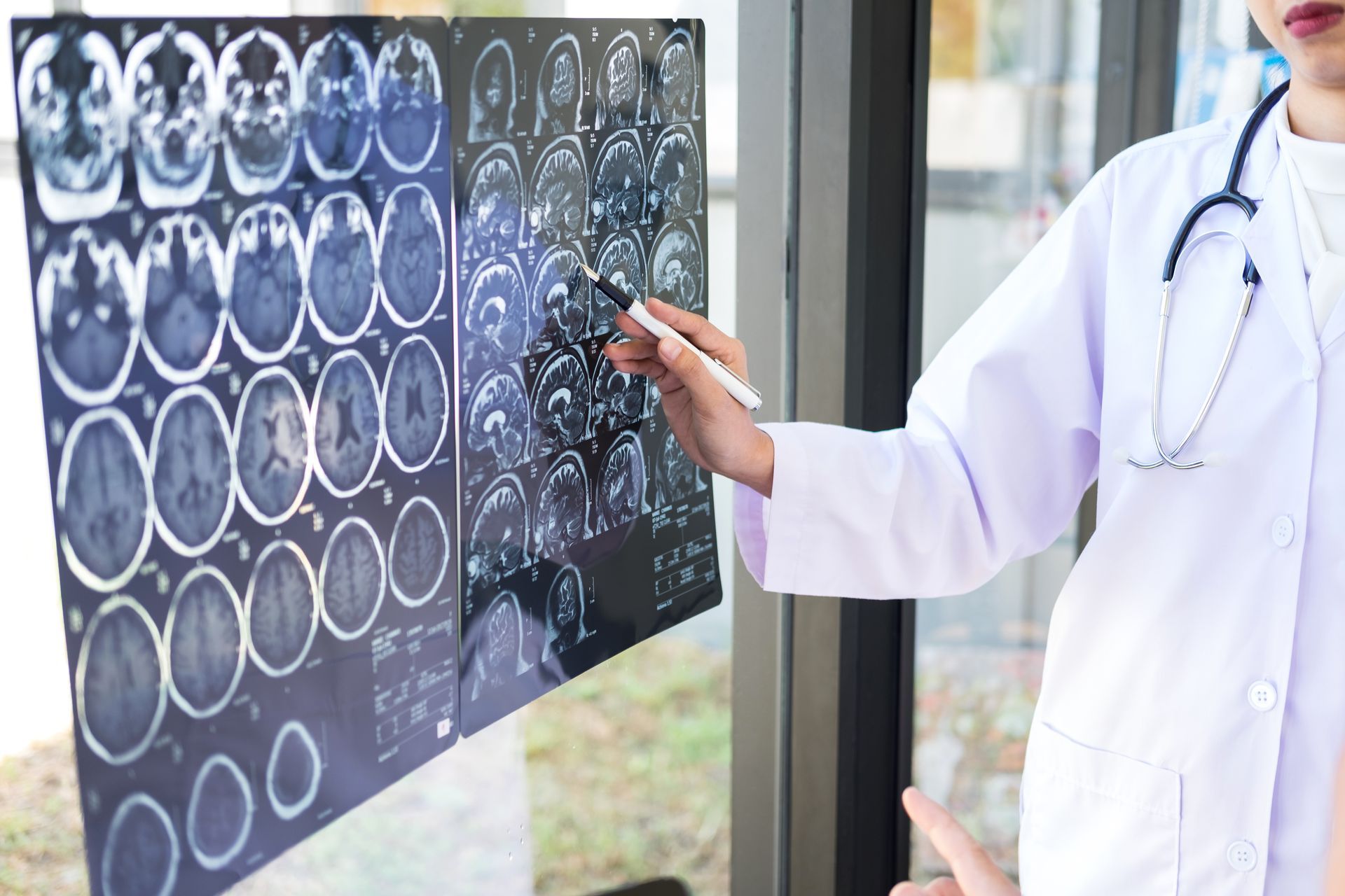 Embolização de aneurisma cerebral em Vinhedo: Quando é indicada?