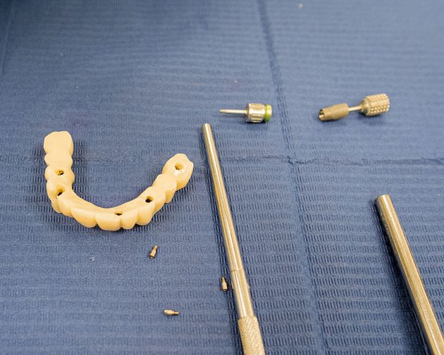 Consulenza per implantologia dentale