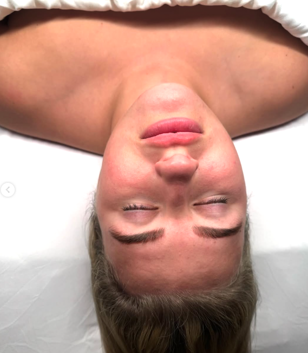 dermaplane