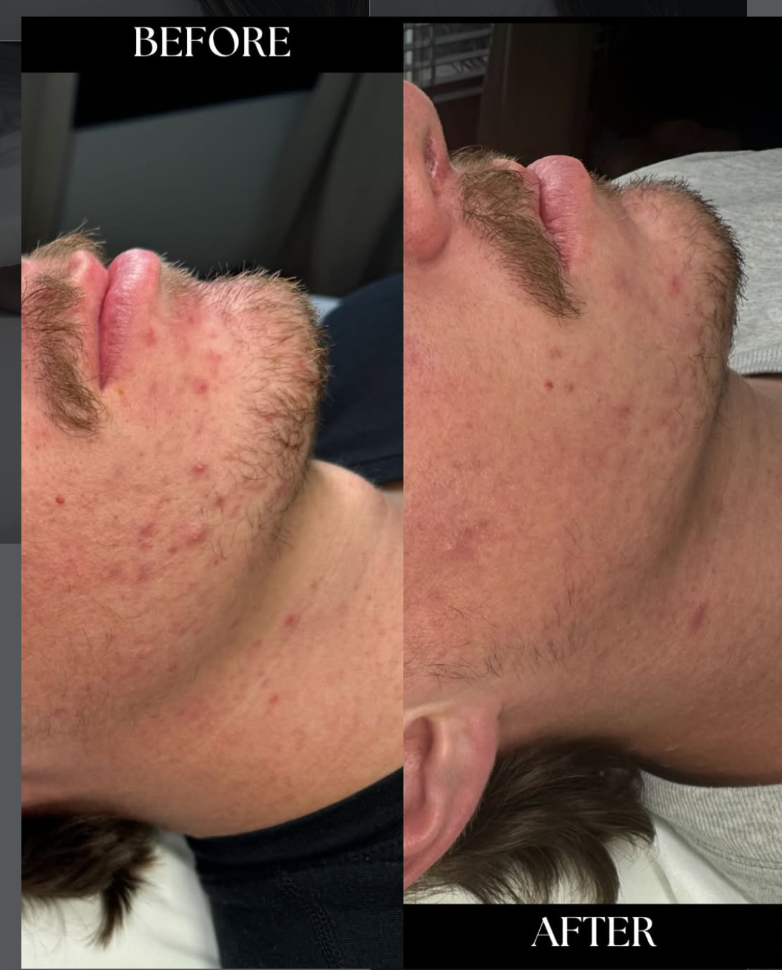 chemical peel