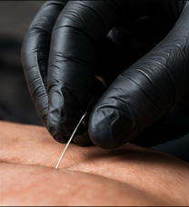 Gloved hands inserting a thin acupuncture needle into bare skin close-up