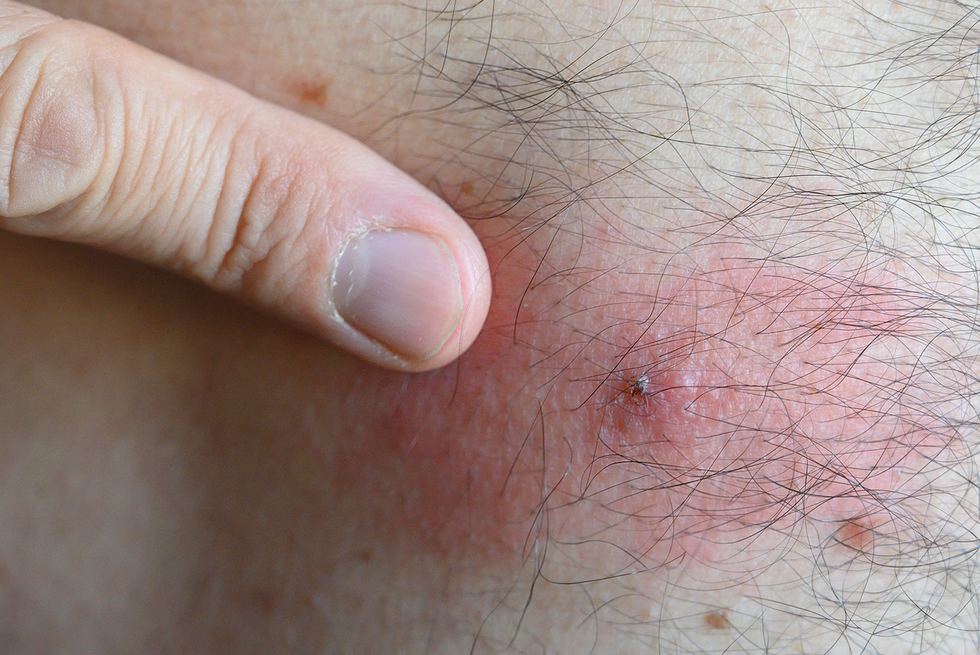 A person is pointing at a pimple on their stomach.