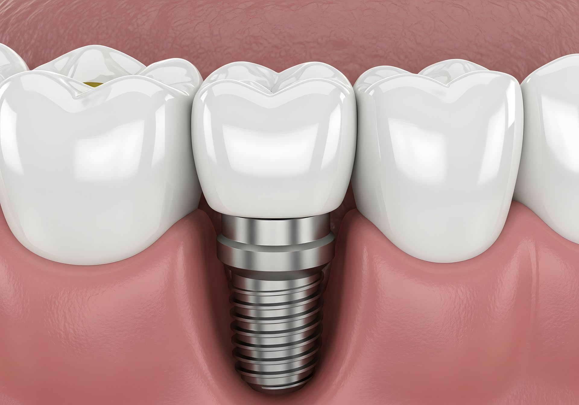 Single Tooth Replacement