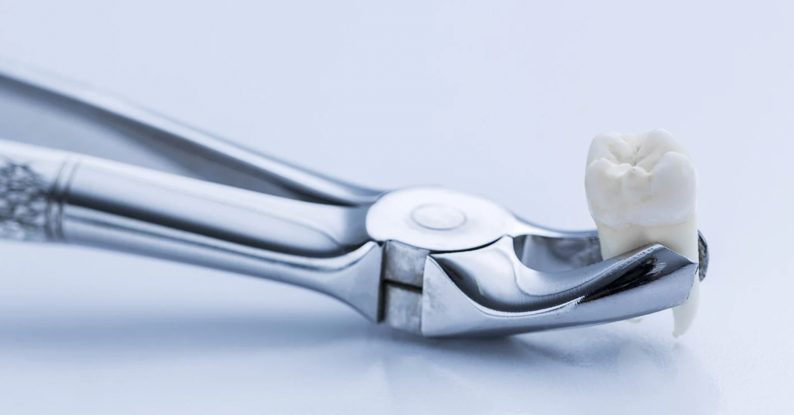 Signs you may need a tooth extraction
