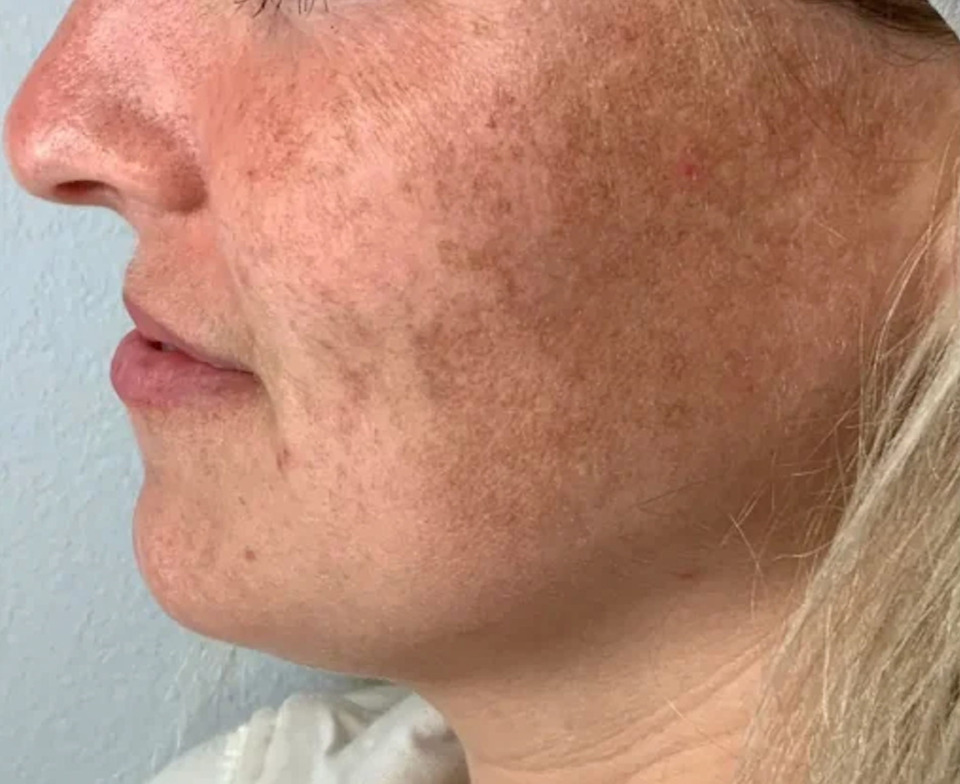 Close-up side profile of a woman’s face showing brown spots on the cheek and jawline.