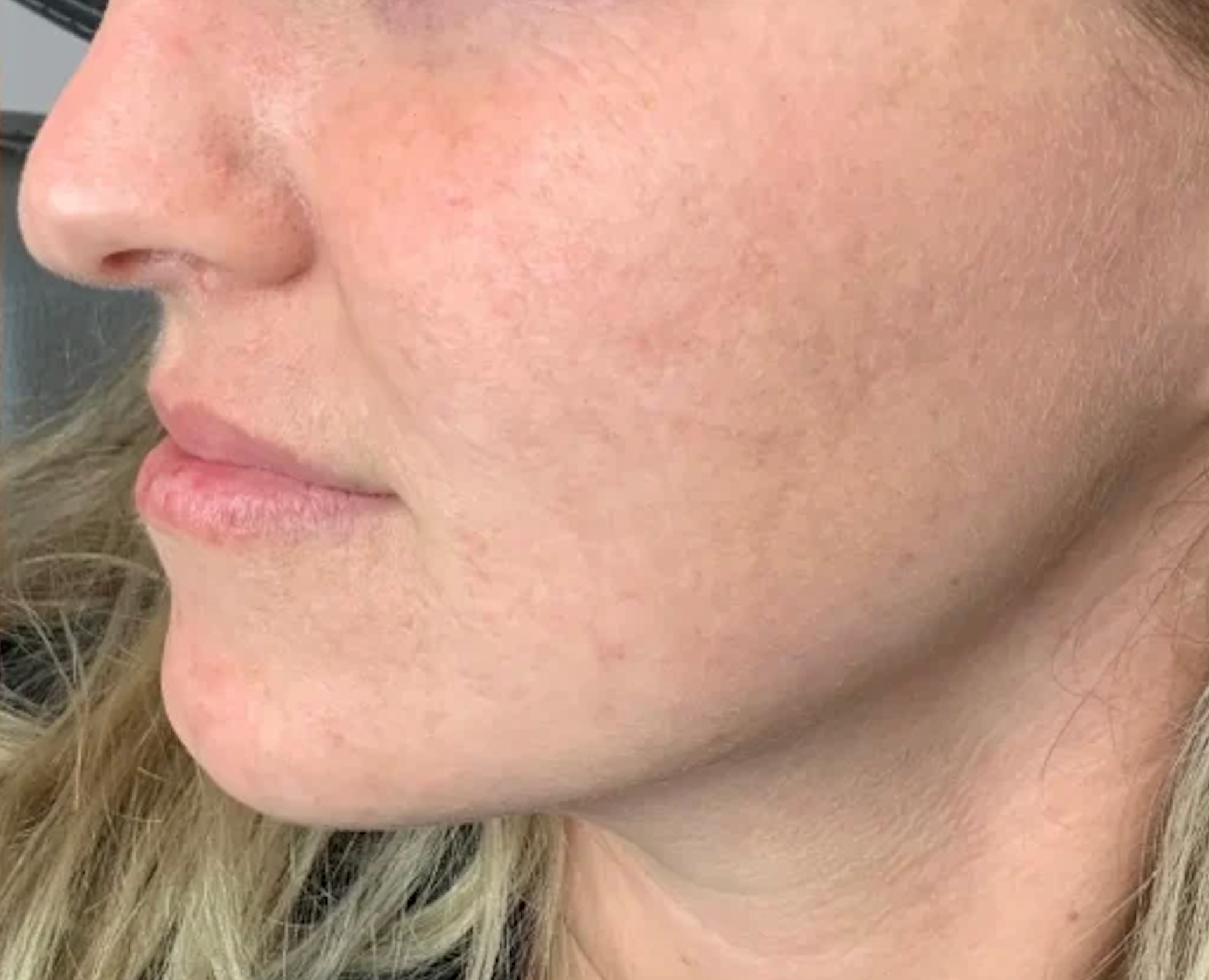 Close-up side view of a person's cheek and jawline with natural skin texture and lips visible