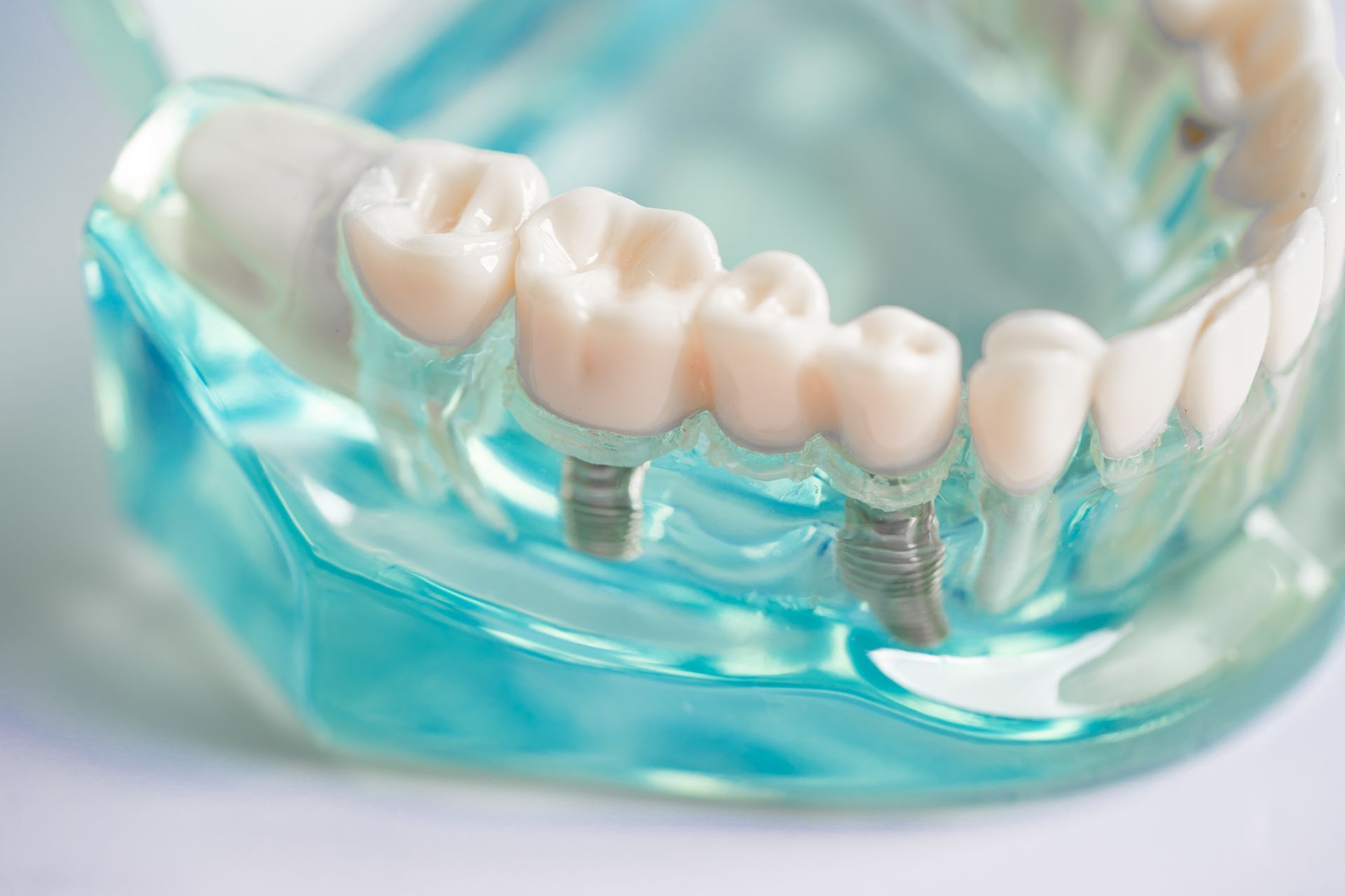 Dental implant model with artificial teeth and metal posts in a clear blue gum model