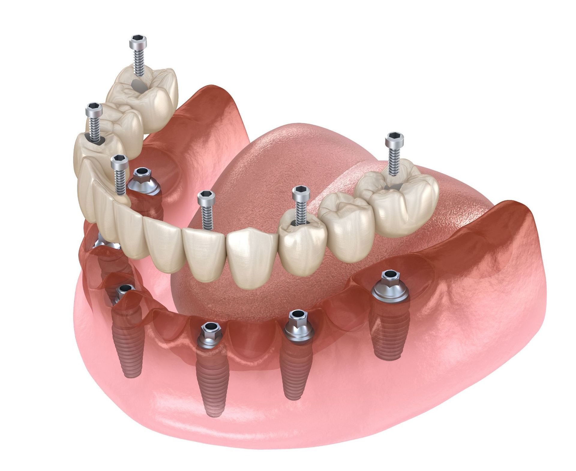 All-on-6 Dental Implants