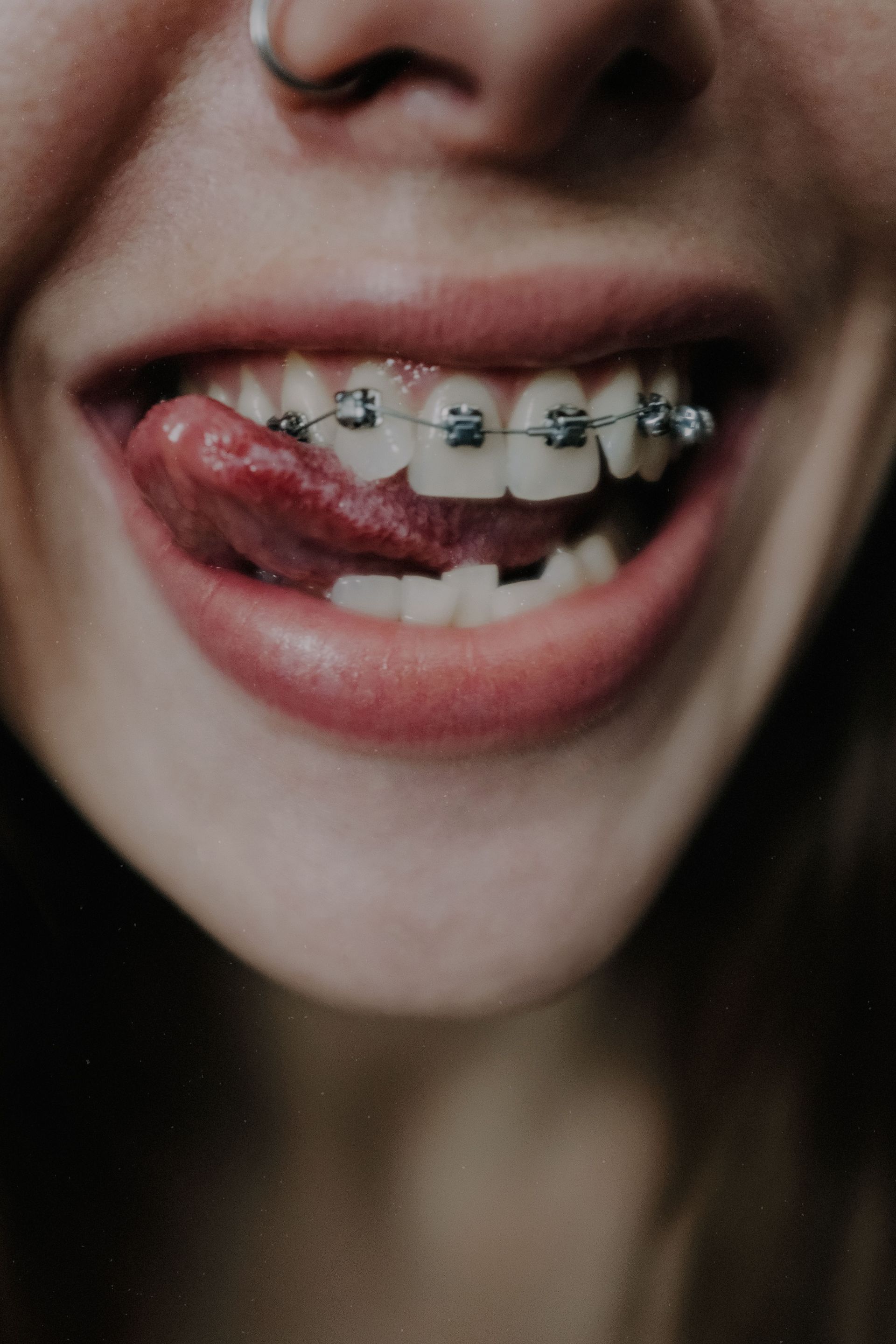 Traditional braces for teeth straightening