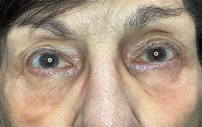 Close-up of a person’s eyes with dark under-eye circles and a tired expression