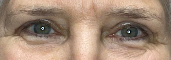 Close-up of a person’s blue eyes and upper face with faint wrinkles, looking straight ahead