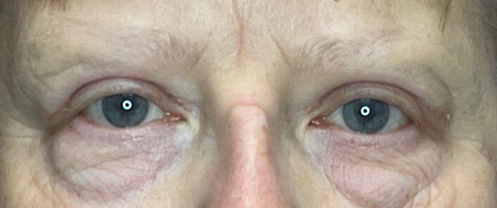 Close-up of a person’s eyes and upper nose, looking straight ahead