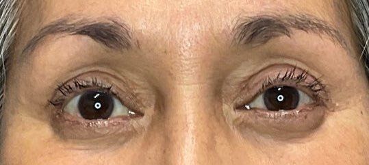 Close-up of a person’s eyes with slight redness around the lower lids