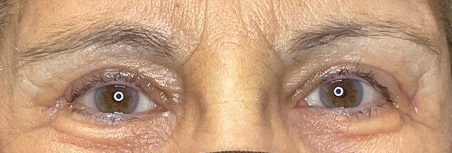 Close-up of a person’s eyes with purple eye makeup and dark under-eye circles