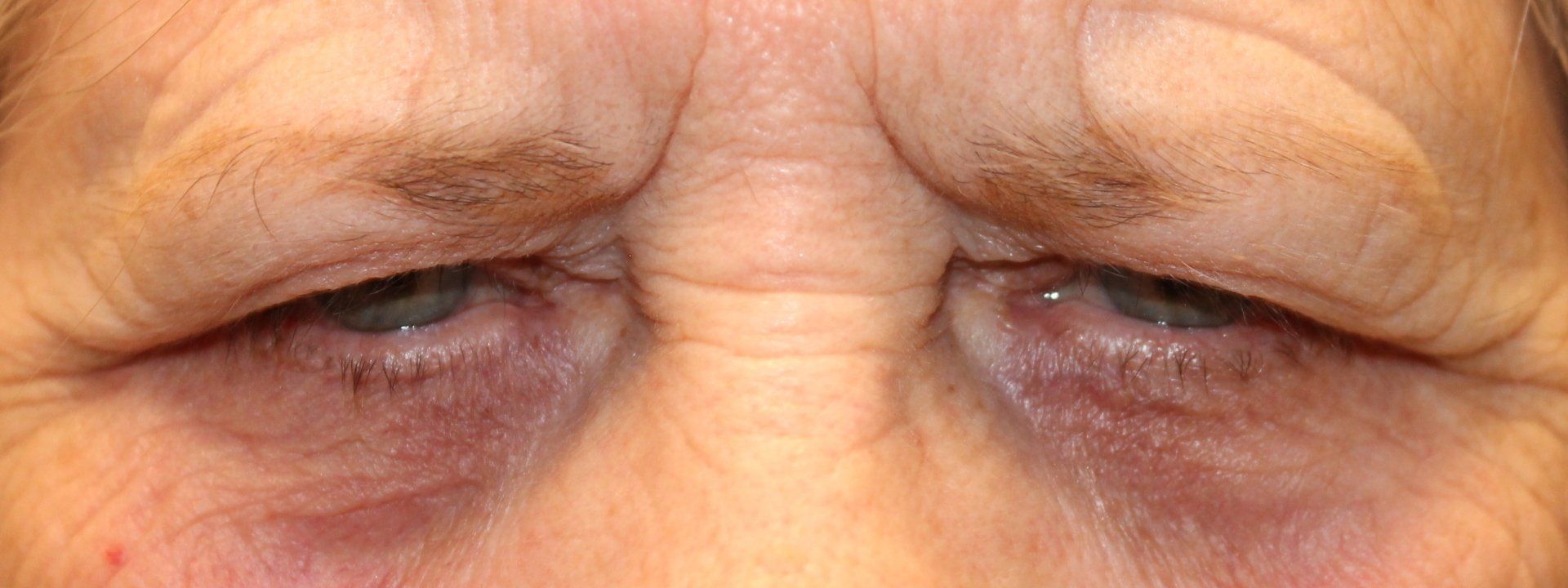 Close-up of two tired eyes with red, puffy skin around them