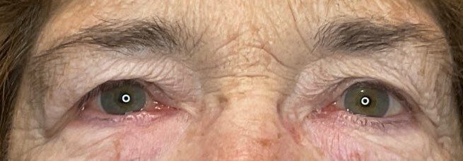 after eyelid surgery