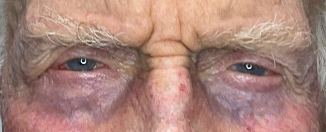 Close-up of an elderly man's eyes with visible redness and wrinkles, looking forward