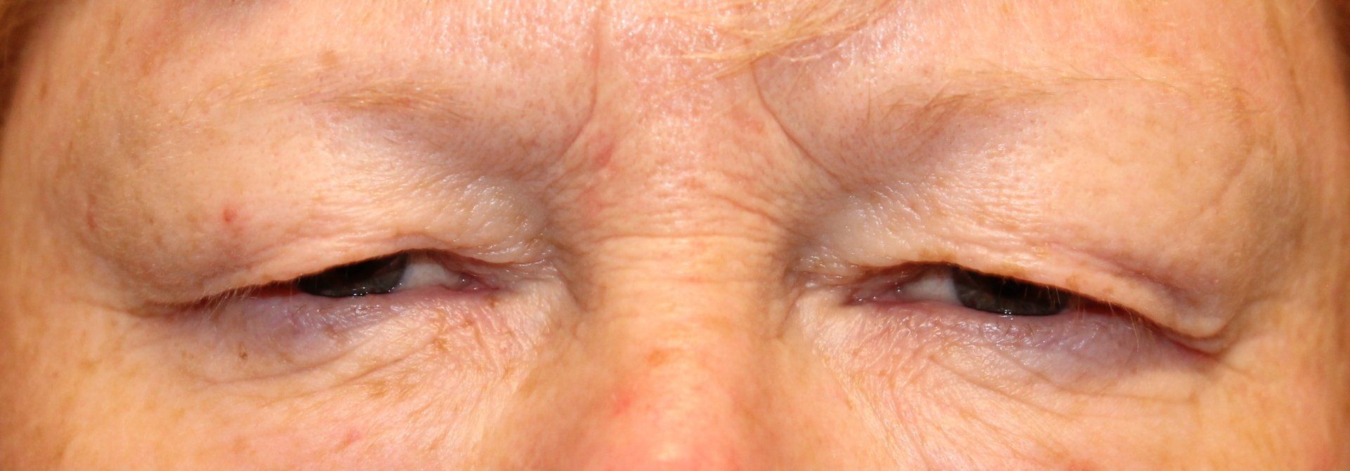 Close-up of a person’s eyes with slight puffiness and closed eyelids