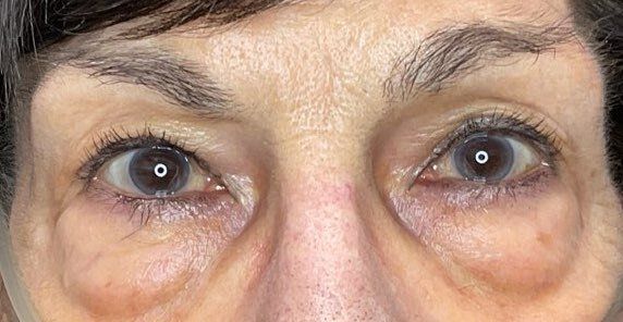 Close-up of a woman's eyes with dark circles and slight redness underneath