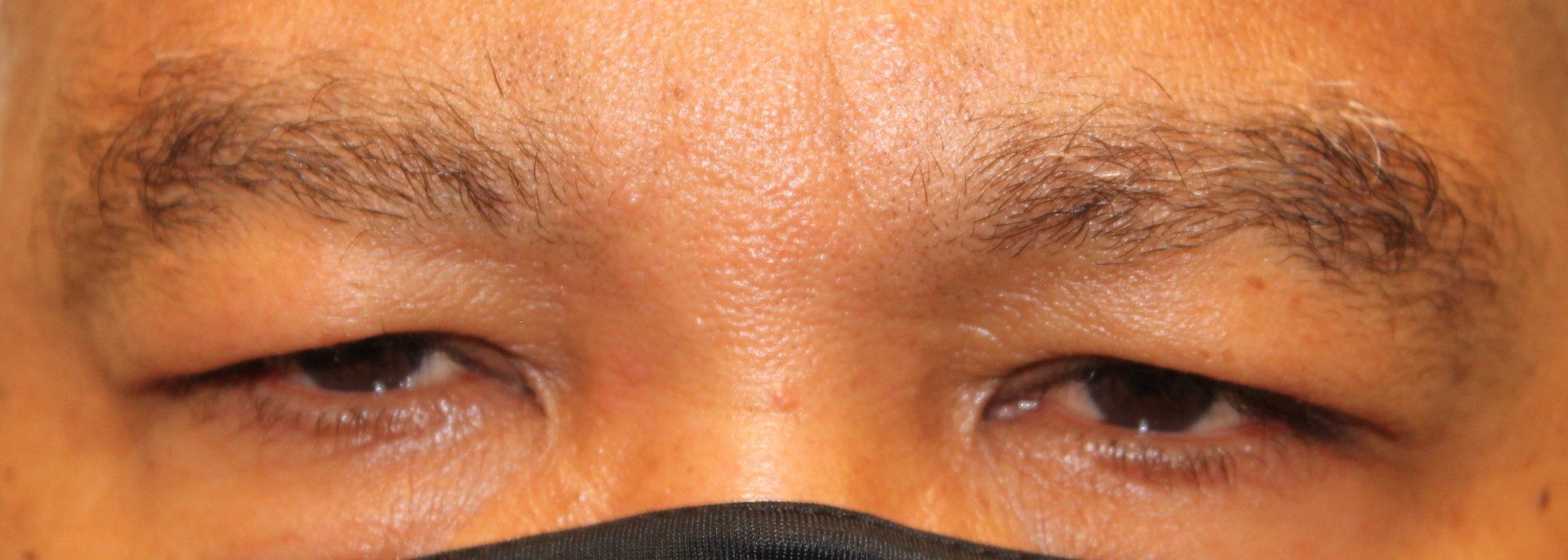 Close-up of a person's eyes with swollen, irritated eyelids, partially covered by a black mask