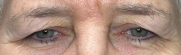 Close-up of a person’s eyes with dark circles and wrinkles around the lids