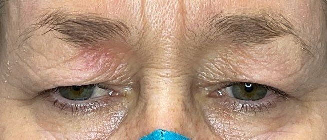 Close-up of tired-looking eyes with a blue face mask at the bottom edge