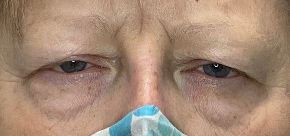 Close-up of tired eyes above a blue surgical mask