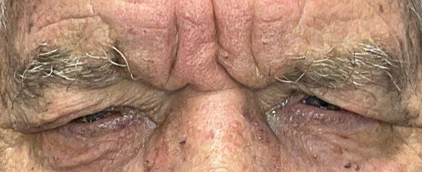 Close-up of a man's eyes with visible wrinkles and dark bruising around both eyelids