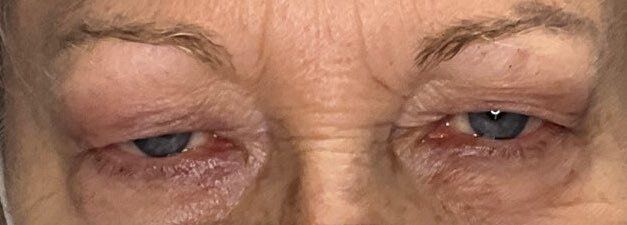 Close-up of a person's eyes with red, swollen eyelids and dark under-eye circles