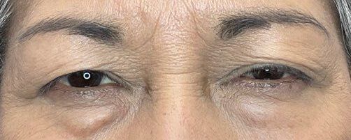 Close-up of a person’s eyes with slight under-eye puffiness and wrinkled skin.