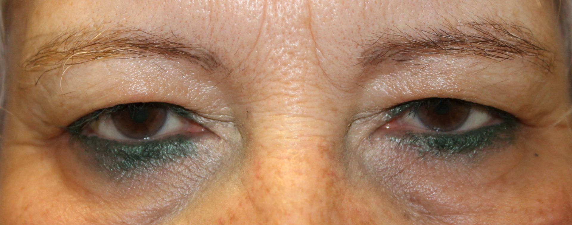Close-up of a person’s eyes with dark bruising and discoloration around both eyelids