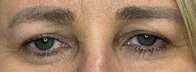 Close-up of two tired eyes with dark under-eye circles and faint wrinkles