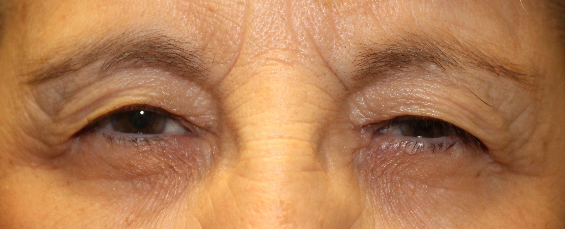 Close-up of tired eyes with dark under-eye circles and one eye partly closed