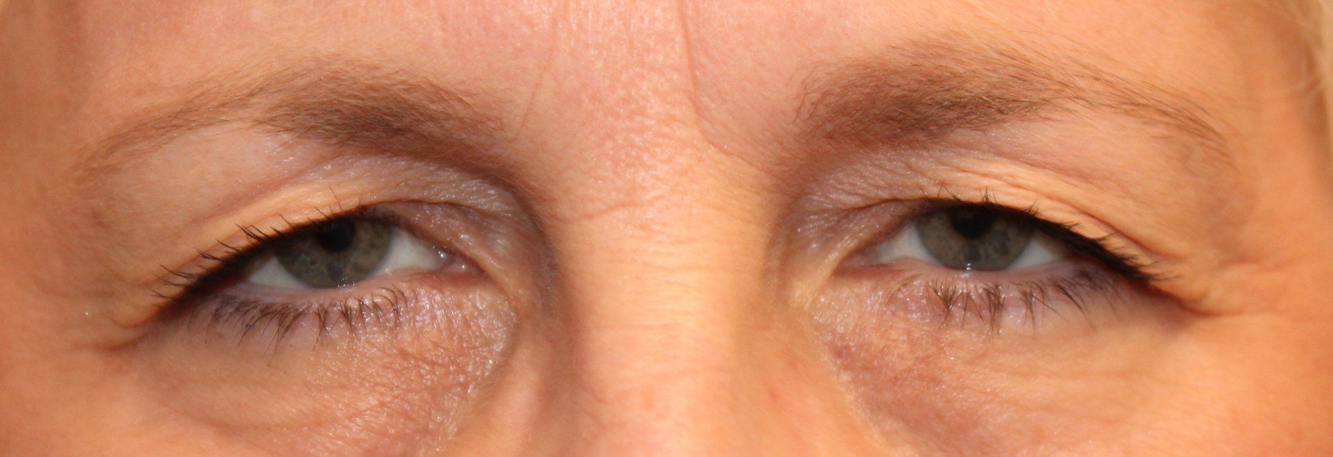 Close-up of a person’s eyes and upper nose, with a neutral expression.