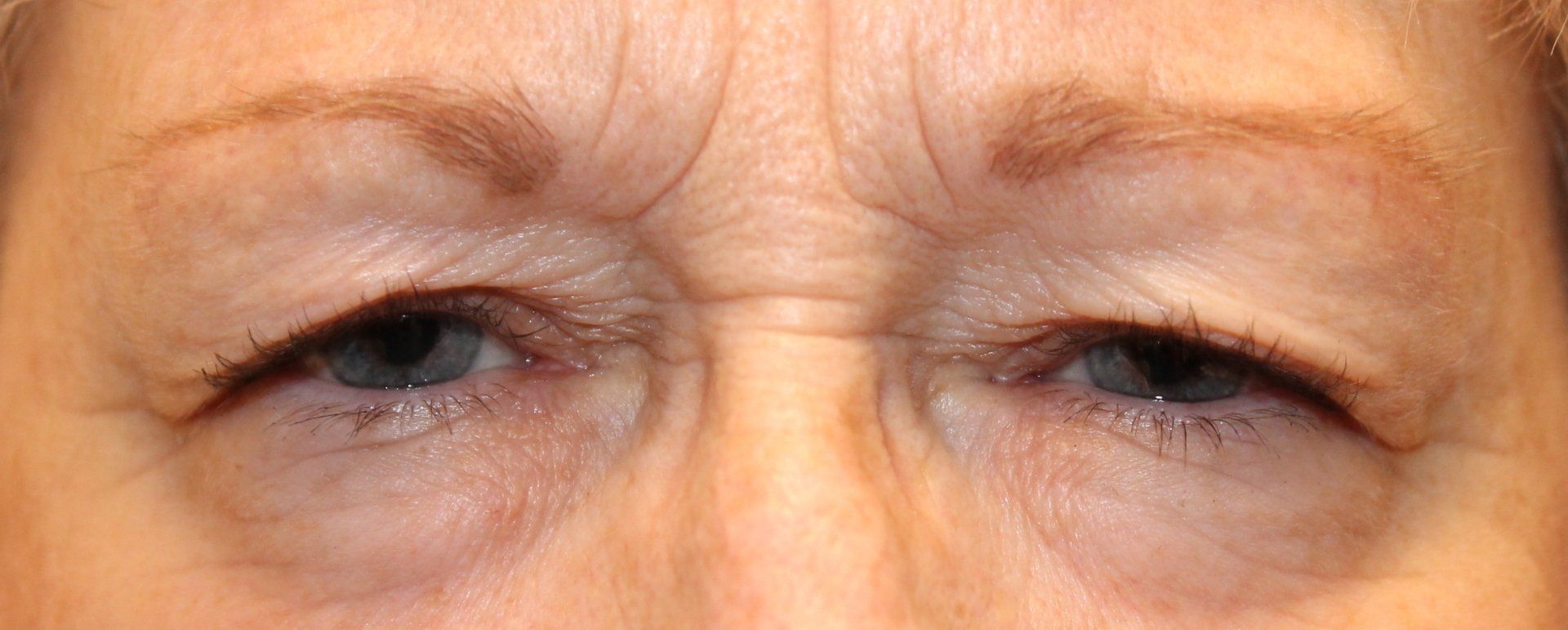 Close-up of a person’s eyes squinting slightly, with visible wrinkles on the forehead and around the eyes