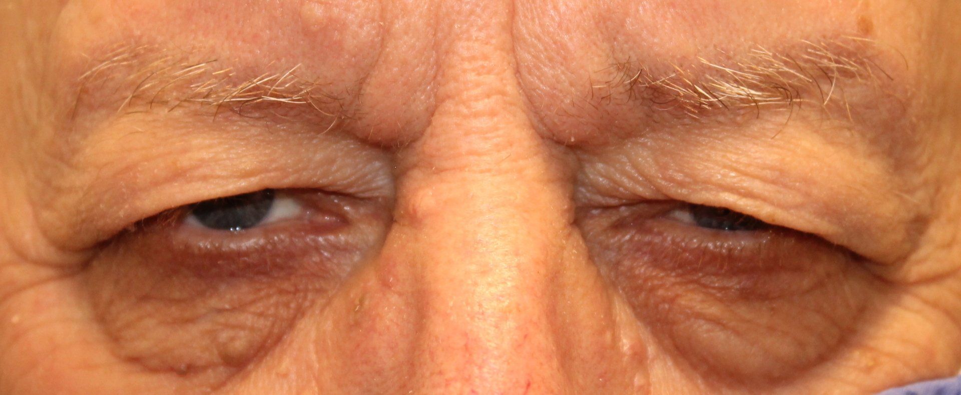 Close-up of a person's eyes, partially closed, with wrinkled skin