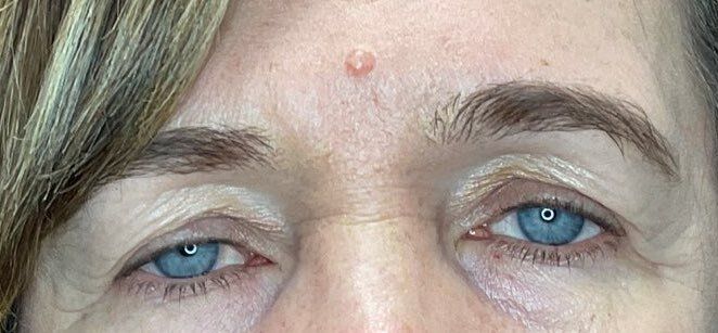 Close-up of a person’s eyes and forehead with a small red bump above the left eyebrow.