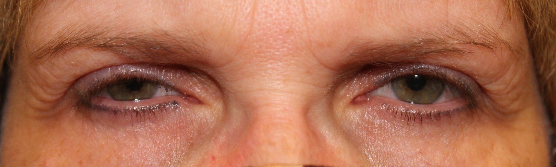 Close-up of tired eyes with drooping eyelids and dark under-eye circles
