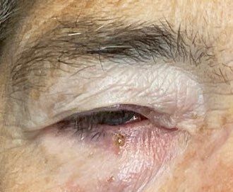 before eyelid surgery