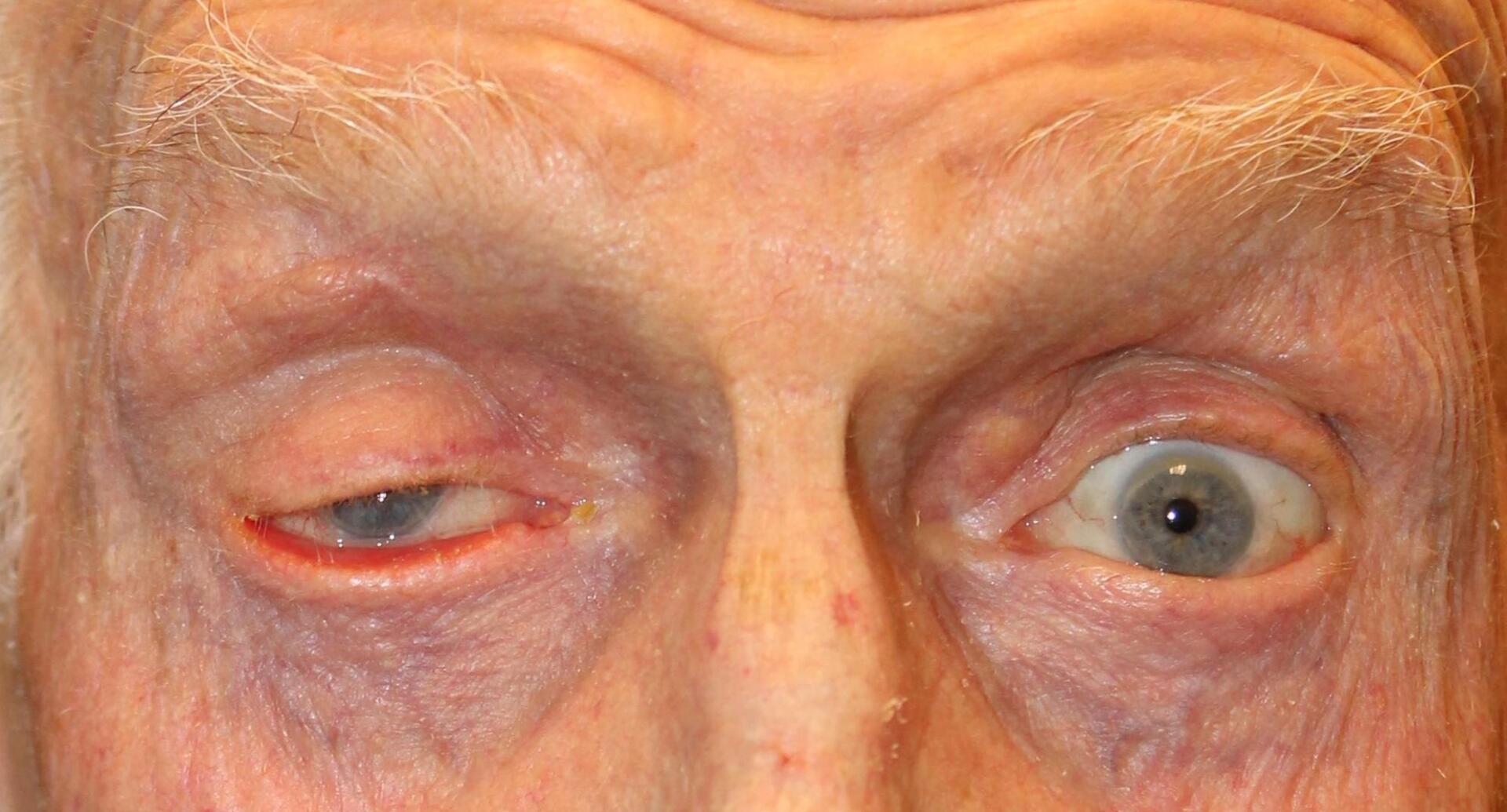 Close-up of a person’s eyes, one red and swollen, the other wide open and blue.