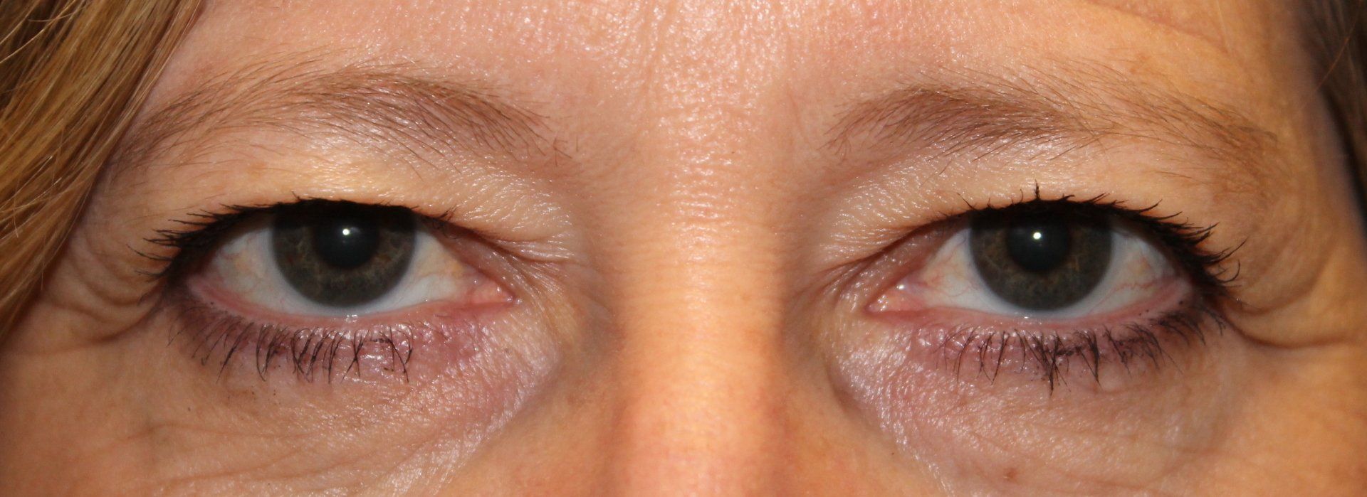 Close-up of a person’s eyes with dark under-eye circles and a neutral expression