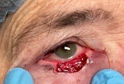 eyelid surgery