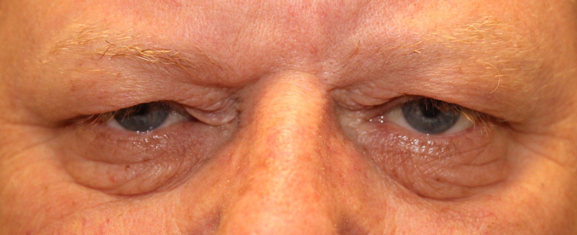 Close-up of a person's eyes and upper face, with one eye slightly drooping