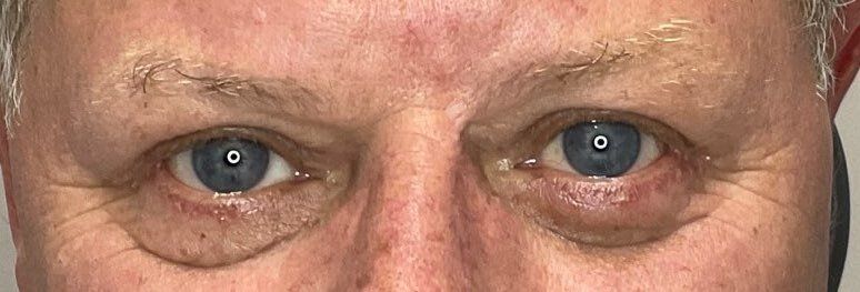 Close-up of a person's blue eyes and brow, with a slight frown and visible wrinkles