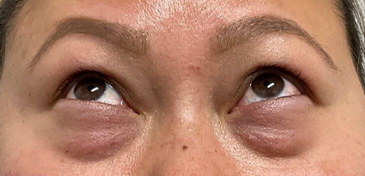 Close-up of eyes looking upward, showing under-eye swelling and dark circles